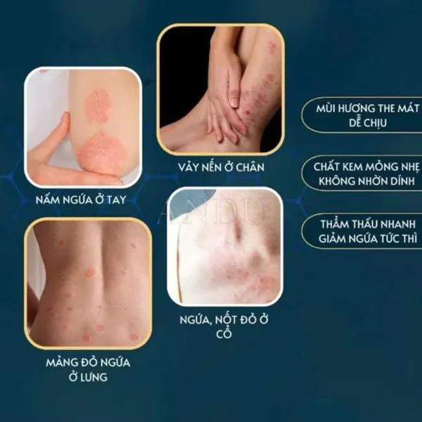 Kem nấm Yunnan, hiệu quả với ngứa, dành cho tay và chân, ra mồ hôi, kháng khuẩn, chỉ sử dụng ngoài da, da khô và ngứa